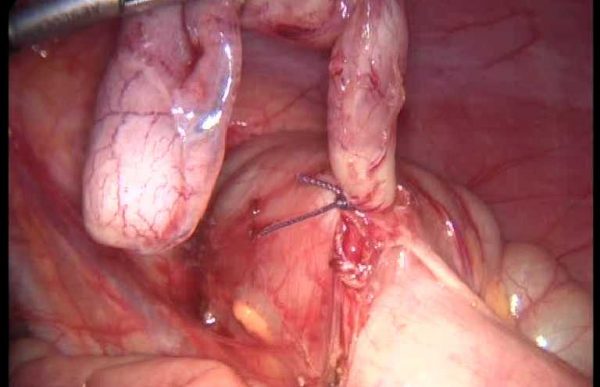 oddelený appendix s podviazanou bázou